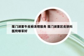 廈門湖里牛皮癬清理服務(wù) 廈門湖里區(qū)皮膚科醫(yī)院哪家好