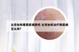 北京協(xié)和看銀屑病貴嗎 北京協(xié)和治療銀屑病怎么樣?
