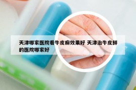 天津哪家醫(yī)院看牛皮癬效果好 天津治牛皮鮮的醫(yī)院哪家好