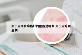 南寧治牛皮癬最好的醫(yī)院是哪家 南寧治療銀屑病