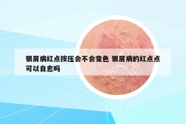 銀屑病紅點(diǎn)按壓會(huì)不會(huì)變色 銀屑病的紅點(diǎn)點(diǎn)可以自愈嗎