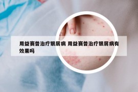用益賽普治療銀屑病 用益賽普治療銀屑病有效果嗎