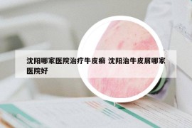 沈陽哪家醫(yī)院治療牛皮癬 沈陽治牛皮屑哪家醫(yī)院好