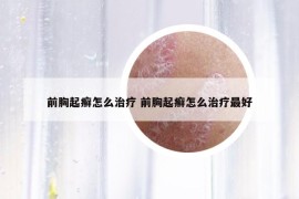 前胸起癬怎么治療 前胸起癬怎么治療最好