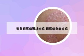 海魚銀屑病可以吃嗎 銀屑病魚能吃嗎