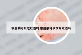 銀屑病可以吃紅酒嗎 銀屑病可以飲用紅酒嗎