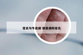腎炎與牛皮癬 銀屑病和腎炎