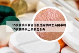 15歲女孩頭發(fā)部位都是蘚很癢怎么回事啊 15歲孩子頭上長癬怎么辦