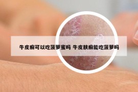 牛皮癬可以吃菠蘿蜜嗎 牛皮膚癬能吃菠蘿嗎