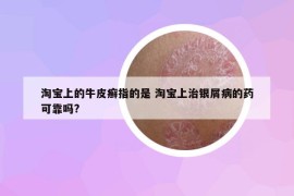 淘寶上的牛皮癬指的是 淘寶上治銀屑病的藥可靠嗎?