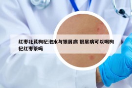 紅棗北芪枸杞泡水與銀屑病 銀屑病可以喝枸杞紅棗茶嗎