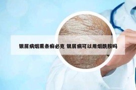 銀屑病煙熏條癬必克 銀屑病可以用煙酰胺嗎