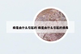 癬是由什么引起的 癬是由什么引起的病毒