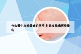 包頭看牛皮癬最好的醫(yī)院 包頭皮膚病醫(yī)院排名