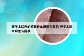 脖子上紅色的癬是什么原因引起的 脖子上起紅癬怎么回事