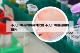 小兒汗斑與白癜風(fēng)對比圖 小兒汗斑最初期的圖片
