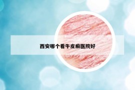 西安哪個(gè)看牛皮癬醫(yī)院好