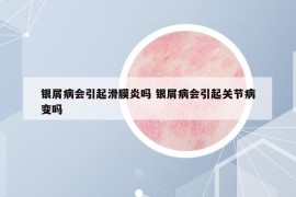 銀屑病會(huì)引起滑膜炎嗎 銀屑病會(huì)引起關(guān)節(jié)病變嗎