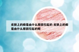 皮膚上的癬是由什么原因引起的 皮膚上的癬是由什么原因引起的呢