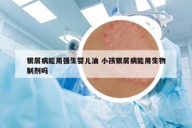 銀屑病能用強(qiáng)生嬰兒油 小孩銀屑病能用生物制劑嗎