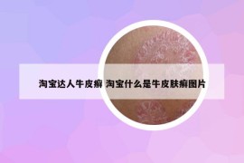 淘寶達人牛皮癬 淘寶什么是牛皮膚癬圖片