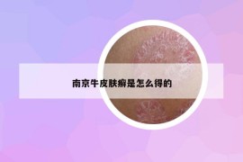 南京牛皮膚癬是怎么得的