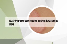 臨汾專業(yè)銀屑病醫(yī)院在哪 臨汾哪家皮膚病醫(yī)院好