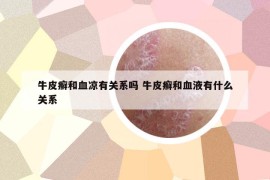 牛皮癬和血涼有關(guān)系嗎 牛皮癬和血液有什么關(guān)系