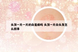 頭頂一片一片的白是癬嗎 頭頂一片白頭發(fā)怎么回事