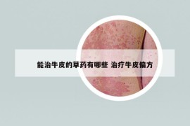 能治牛皮的草藥有哪些 治療牛皮偏方
