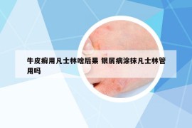 牛皮癬用凡士林啥后果 銀屑病涂抹凡士林管用嗎