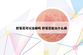 野菊花可以治癬嗎 野菊花能冶什么病