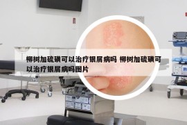 柳樹(shù)加硫磺可以治療銀屑病嗎 柳樹(shù)加硫磺可以治療銀屑病嗎圖片