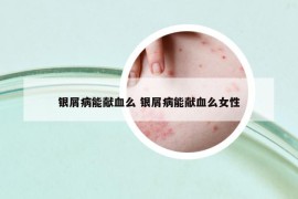 銀屑病能獻血么 銀屑病能獻血么女性