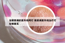 治銀屑病的紫外線烤燈 銀屑病紫外線治療燈在哪里買