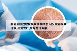 臉部皮膚過(guò)敏反復(fù)發(fā)紅發(fā)癢怎么辦 臉部皮膚過(guò)敏,反復(fù)發(fā)紅,發(fā)癢是什么病