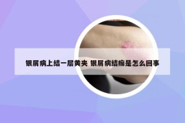 銀屑病上結(jié)一層黃夾 銀屑病結(jié)痂是怎么回事