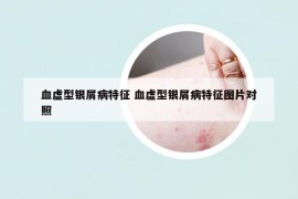 血虛型銀屑病特征 血虛型銀屑病特征圖片對(duì)照