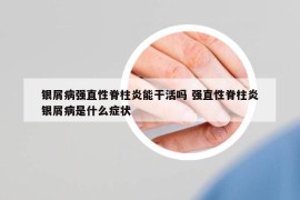 銀屑病強(qiáng)直性脊柱炎能干活嗎 強(qiáng)直性脊柱炎銀屑病是什么癥狀