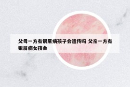 父母一方有銀屑病孩子會(huì)遺傳嗎 父親一方有銀屑病女孩會(huì)