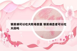 銀屑病可以吃大敗毒膠囊 銀屑病患者可以吃大蒜嗎