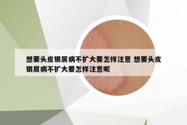 想要頭皮銀屑病不擴(kuò)大要怎樣注意 想要頭皮銀屑病不擴(kuò)大要怎樣注意呢