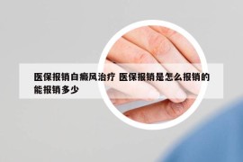 醫(yī)保報(bào)銷白癜風(fēng)治療 醫(yī)保報(bào)銷是怎么報(bào)銷的能報(bào)銷多少