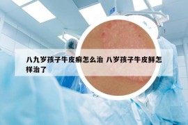 八九歲孩子牛皮癬怎么治 八歲孩子牛皮鮮怎樣治了