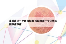 皮膚出現(xiàn)一個(gè)環(huán)狀紅圈 皮膚出現(xiàn)一個(gè)環(huán)狀紅圈不痛不癢