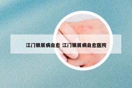 江門銀屑病自愈 江門銀屑病自愈醫(yī)院