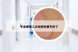 牛皮癬第二次光照效果不好了