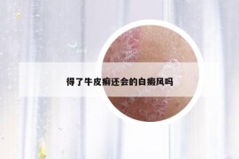 得了牛皮癬還會的白癜風嗎