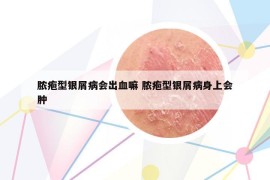 膿皰型銀屑病會出血嘛 膿皰型銀屑病身上會腫