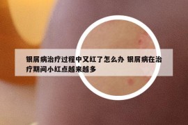 銀屑病治療過程中又紅了怎么辦 銀屑病在治療期間小紅點越來越多